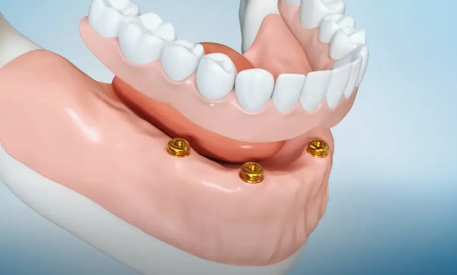 Implanty dentystyczne a protezy - co wybrać?