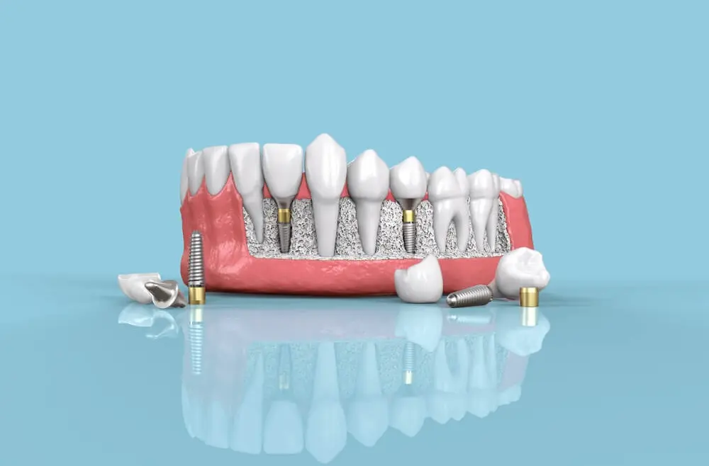 Osteointegracja – kluczowy proces po zabiegu implantacji